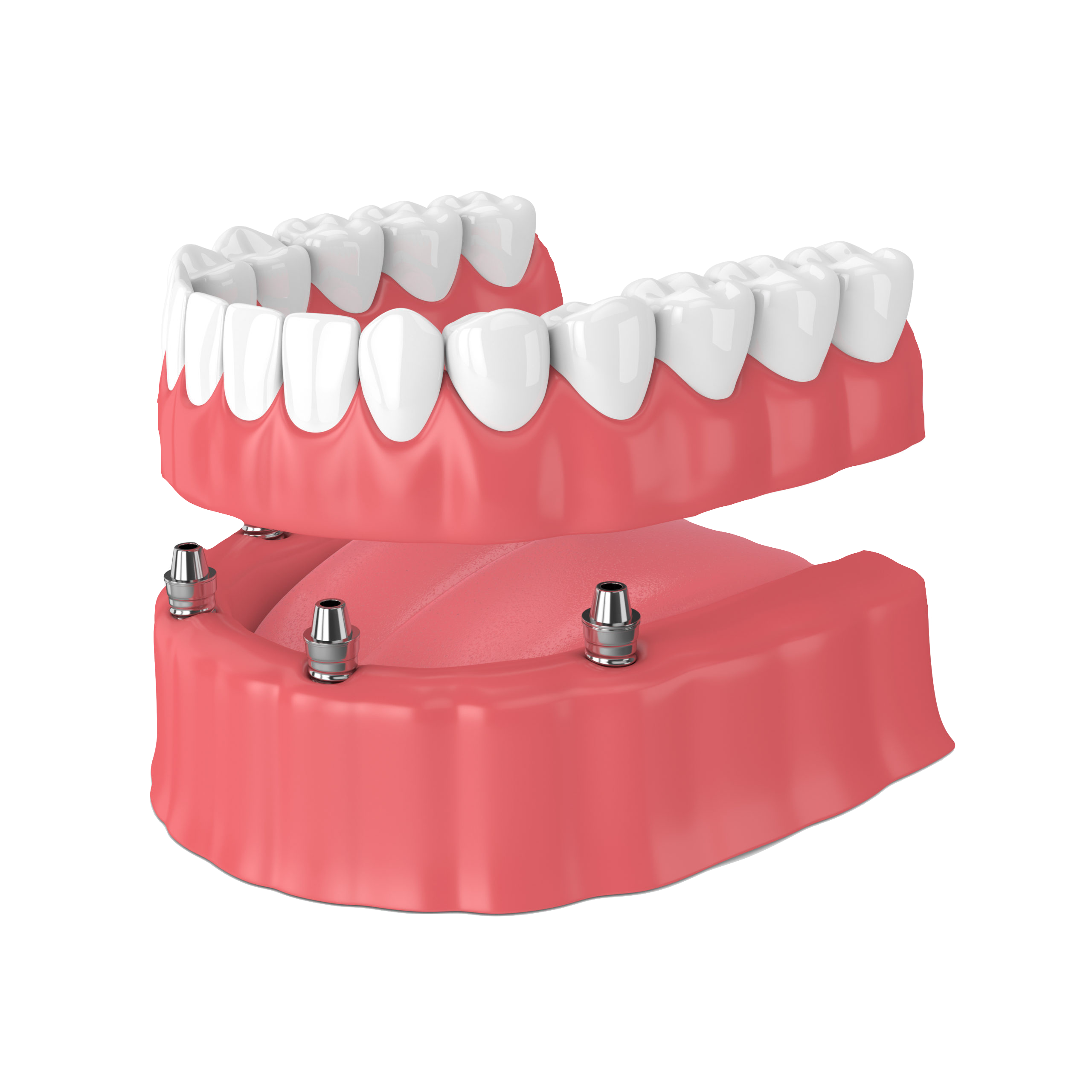 Implantsupported dentures(Snapon) Best Dental Care Implant Center